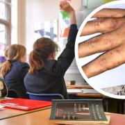 Norfolk County Council issued a scabies fact sheet to schools amid a nationwide rise in cases